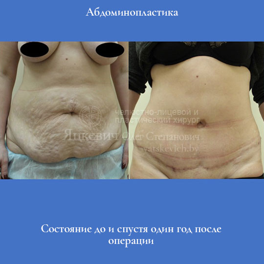 Абдоминопластика — коррекция тканей передней брюшной стенки