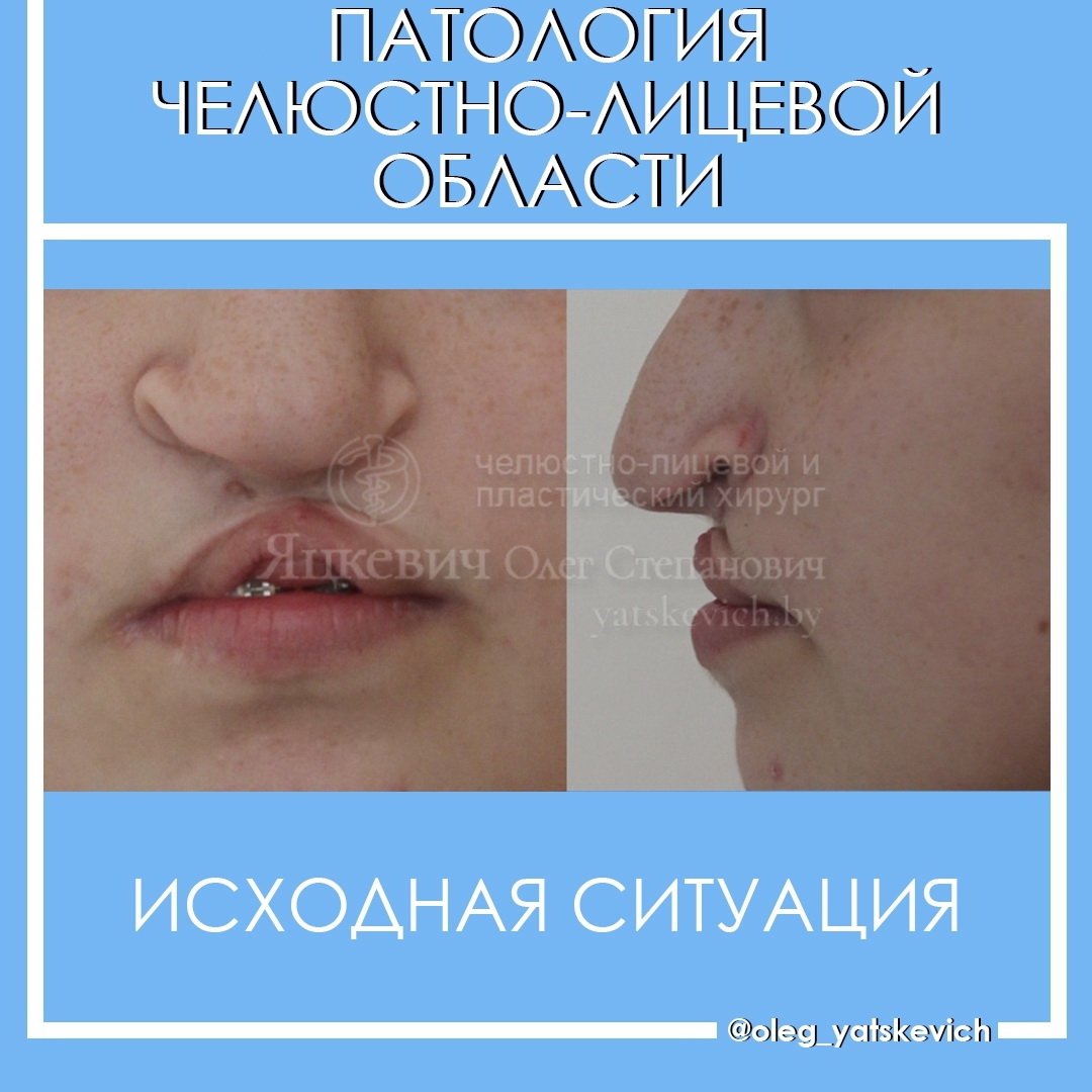 Коррекция типичной деформации верхней губы и носа после врождённых расщелин губы и нёба