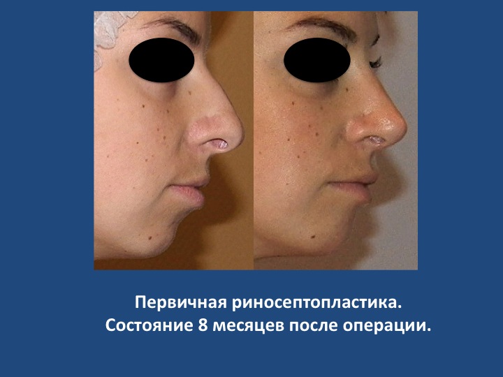 Риносептопластика — коррекция формы носа с одномоментной коррекцией деформаций носовой перегородки