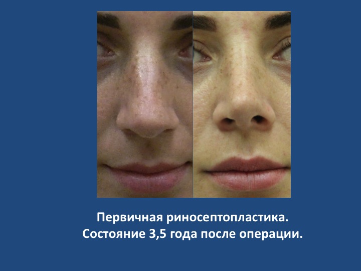 Риносептопластика — коррекция формы носа с одномоментной коррекцией деформаций носовой перегородки